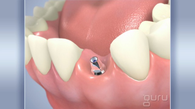 Implant Incisor - One Stage